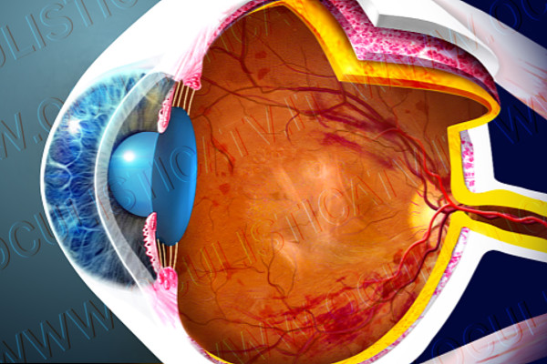 la-retinopatia-diabetica-proliferante-pdr2